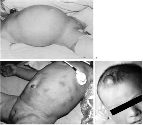 Wow! Indonesia Bisa Sembuhkan Penderita Neuroblastoma Sejak 2012
